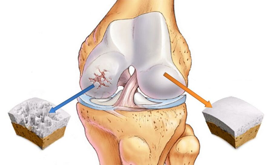 Knee osteoarthritis and healthy cartilage