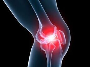 Osteoarthritis of the knee joint causing knee pain