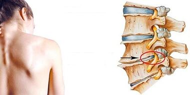 The mechanism of development of cervical osteochondrosis