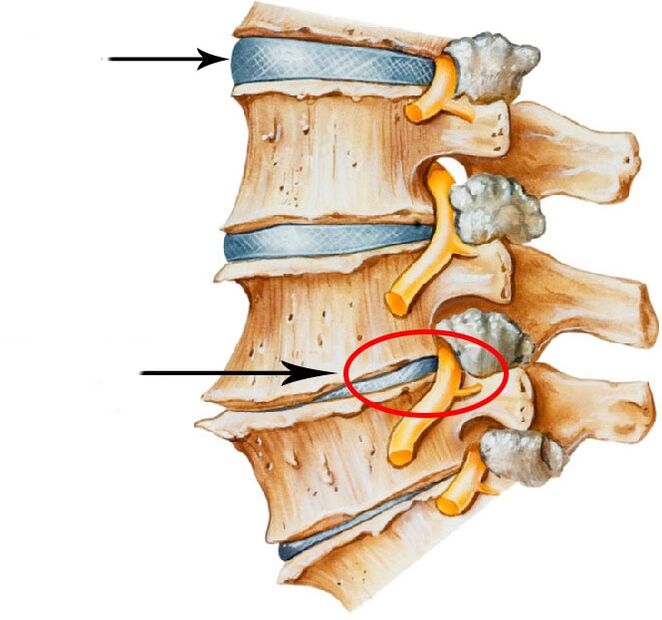 Develop the Hernia Disc