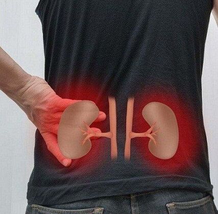 Low pain can occur at pyelonephritis