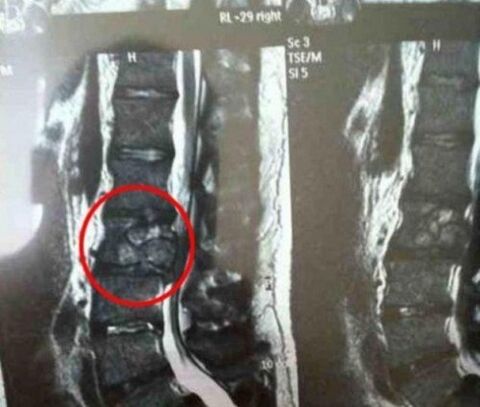 The tumor of the spine in the photo