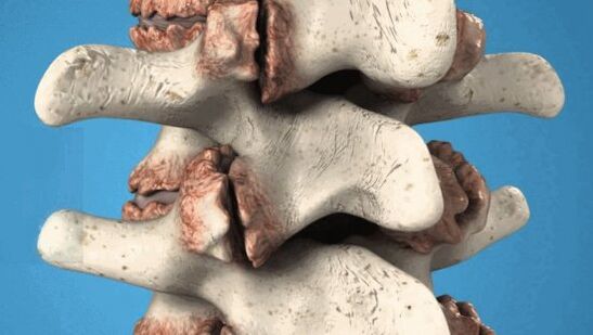 Vertebrae osteophytes - pathological growths that damage the nerves and blood vessels