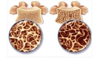 Danger of cervical suction for women