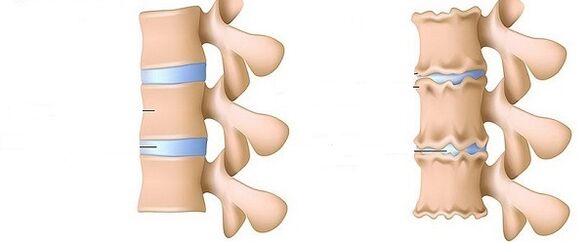 Healthy Spine and Osteochondrosis