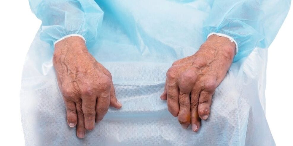 Infectious arthritis is a disease with constant pain and changes in the joints of the fingers.