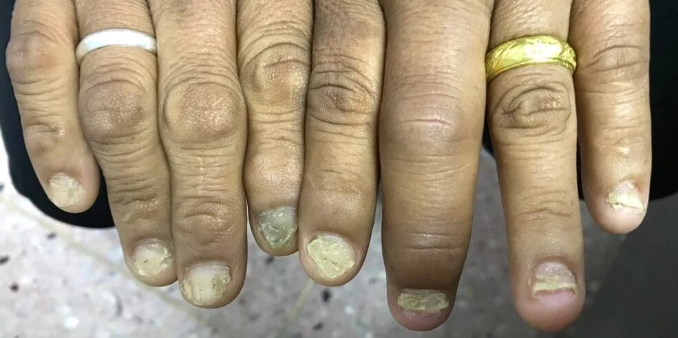 Swelling of the fingers and deformation of the nail plate may indicate the development of psoriatic arthritis