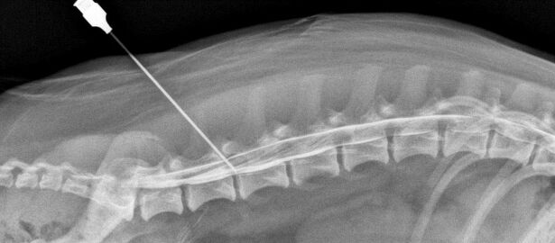 spinal block with osteochondrosis